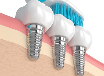Diagram of dental implants in Falmouth being brushed