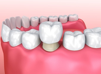 A dental crown