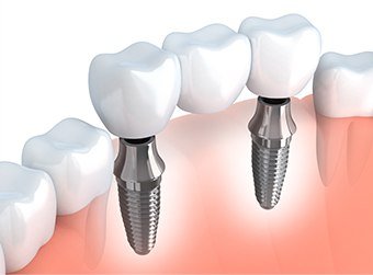 Animation of implant supported fixed bridge