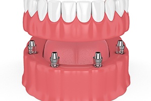 Model of implant supported denture