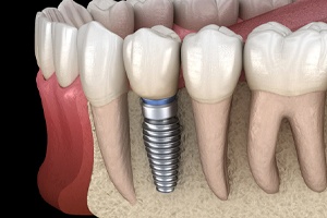 Digital diagram of dental implant after dental implant surgery in Falmouth