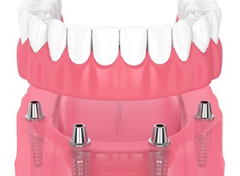 Implant-retained dentures