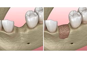 patient’s jawbone before and after bone grafting