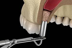 model of a sinus lift procedure