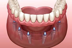 six dental implants supporting a full implant denture