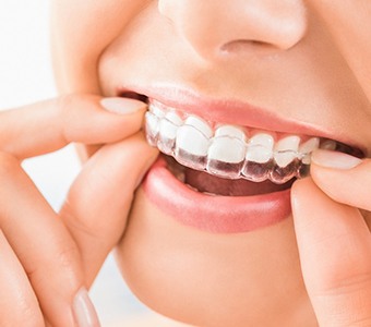 Close up of woman using an Invisalign clear aligner