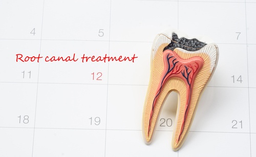 Model of a tooth against a calendar with the words Root Canal Treatment