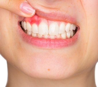 Woman pulling lip showing signs of gum disease