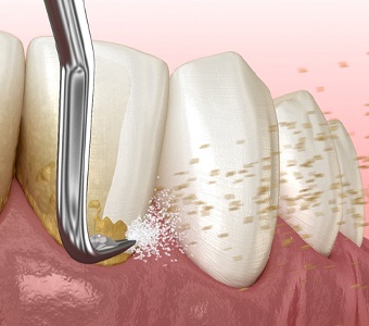Illustration of a scaling and root planing procedure removing plaque