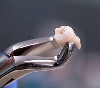 Model of damaged tooth