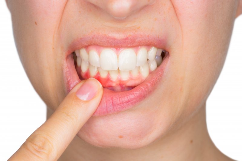 Woman pulling lower lip and showing signs of gum disease