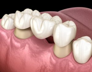 dental bridge in Falmouth replacing a missing tooth 