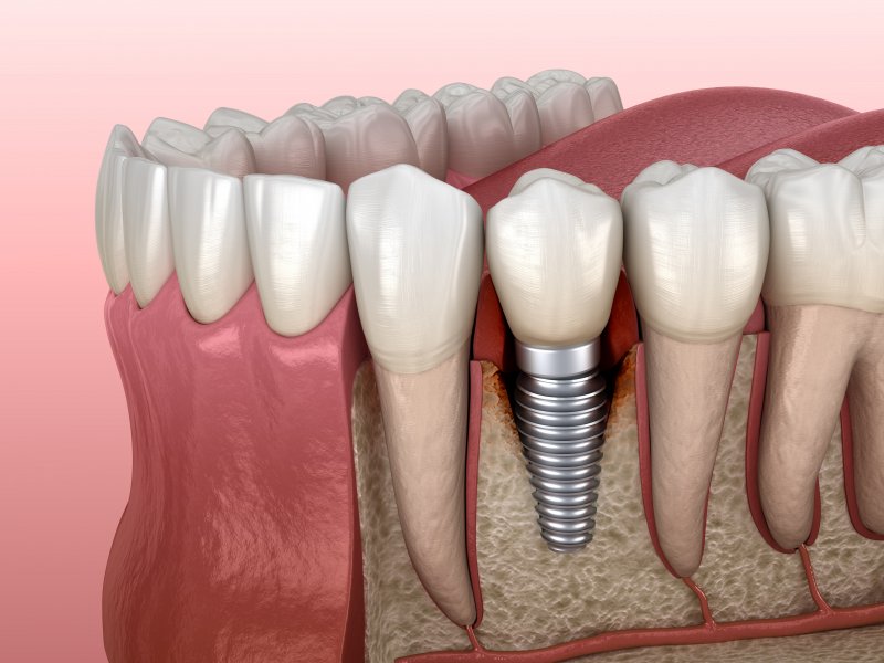 Illustration of a failed dental implant