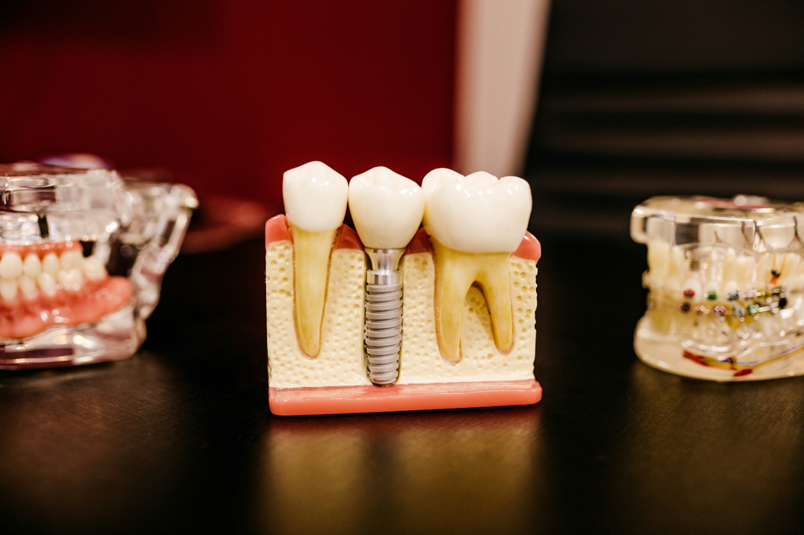 Cutaway dental model showing a titanium implant placed between two natural teeth