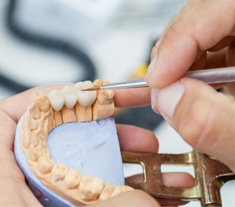 Close-up of a dental bridge restoration being crafted