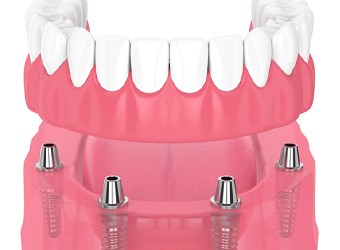 Implant-retained denture showing the snap-in attachment mechanism
