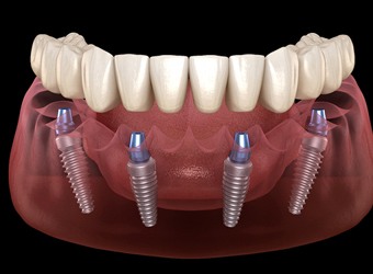 Implant-supported denture model showing how posts anchor the restoration