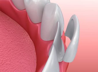 Close-up of a porcelain veneer restoration